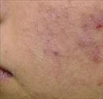 Huile d'argousier, des propriétés contre l'acné