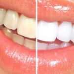 Blanchiment naturel des dents