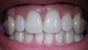 Oil pulling dents blanches