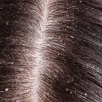 Pellicules cheveux